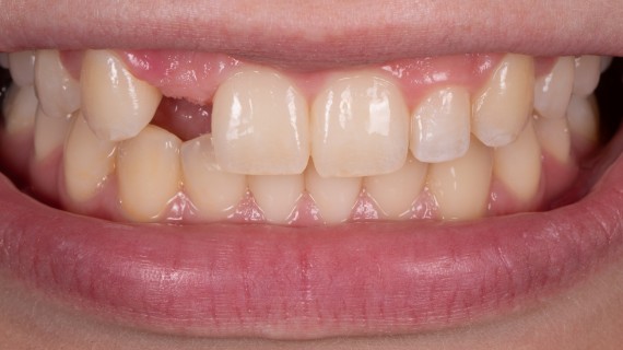 Elegantní řešení chybějící dvojky - foto před